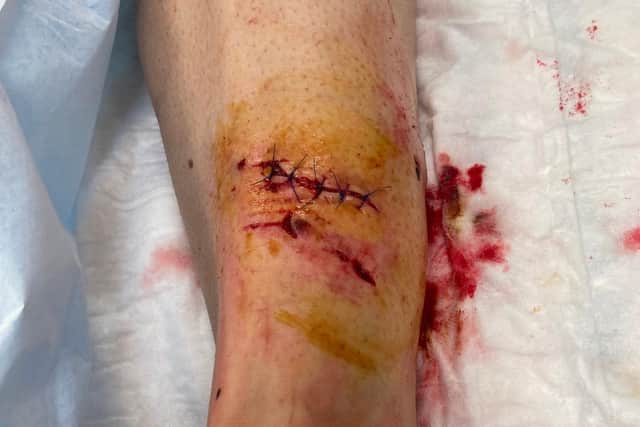 Anna's leg after receiving medical attention.