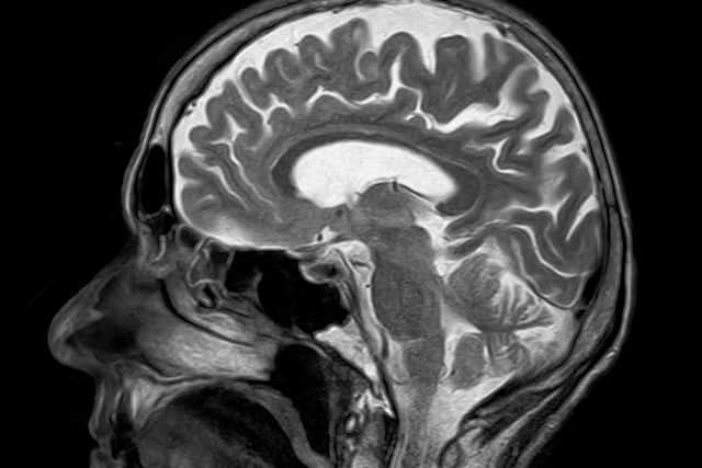 According to Brain Tumour Research, brain tumours kill more children and adults under the age of 40 than any other cancer.