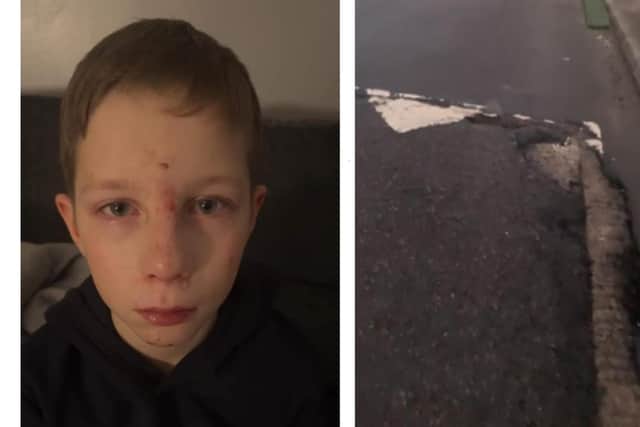 Ten-year-old Jaiden Easton of Methil has two black eyes, a bloodied face, and a potentially broken nose to show for his run in with a damaged speed bump on  Lime Grove (Pics: Submitted)