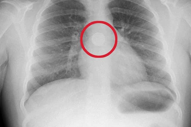 An X-ray of Sarah Wallace's chest after she ate a battery at her home in Kirkcaldy Fife.