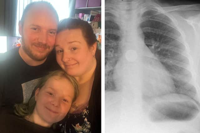 Left, Sarah with mum Joanne and stepdad Jamie. Right, an x-ray of the battery lodged in Sarah's oesophagus