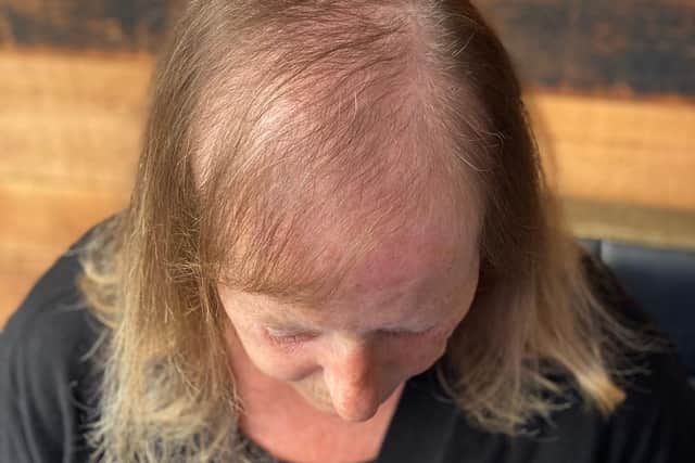 One of Emma's clients who suffers from hair loss preparing to have the mesh integration treatment done.