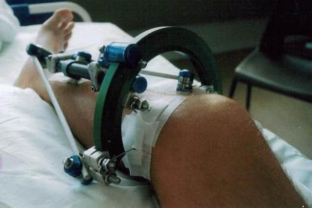 Bob Allison had an external fixator attached to his leg following his injury.